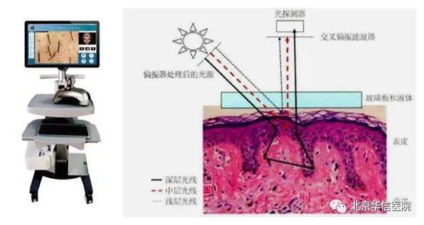 皮肤美容新技术三无创影像诊断技术皮肤镜