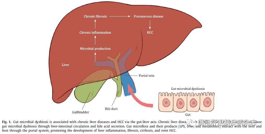 该综述指出通过肝肠轴介导,肠道微生态失衡与肝脏炎性疾病和肝癌密切