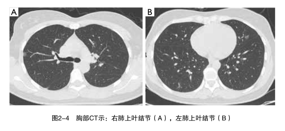 今天走进微浸润性腺癌主题课堂一起学习相关病例肺结节交互印证式诊断