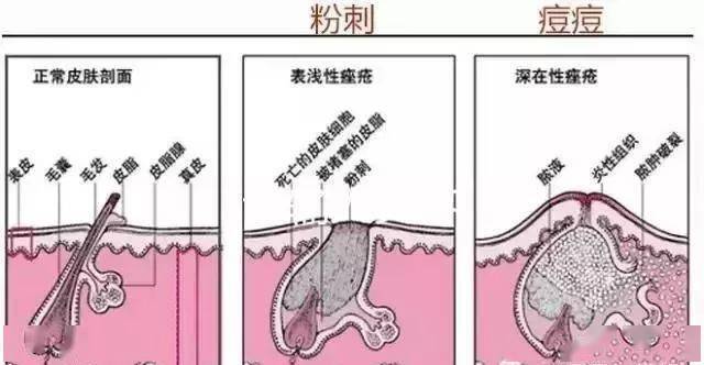 粉刺和痘痘傻傻分不清楚?你还想要美丽?