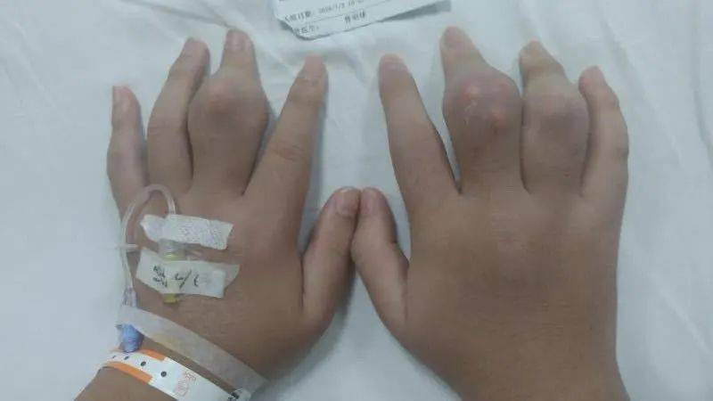 几个月出现一次血便 4d7398c6a8cd46d081e98e985e64c3a6.jpeg