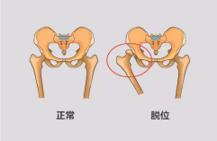 腿纹,臀纹不对称就是髋关节发育有问题?县妇保院儿保科医生带你读懂