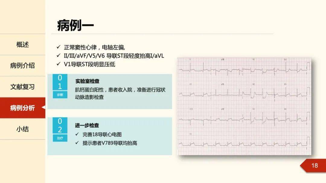 孔令秋教授:正后壁心肌梗死的定位困惑及心电图线索