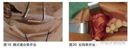 口腔种植手术学图解 组织切开与翻瓣