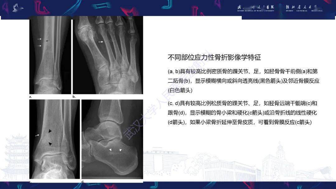 应力性骨折影像学表现