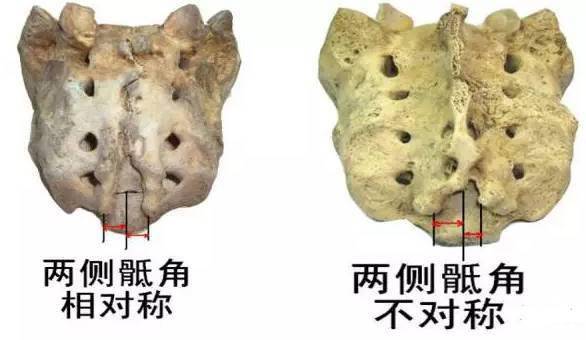 骶骨—常见的解剖变异(图文并茂)