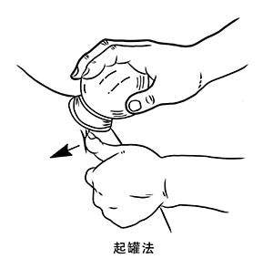 漫说中医| 拔罐 |王守富专栏