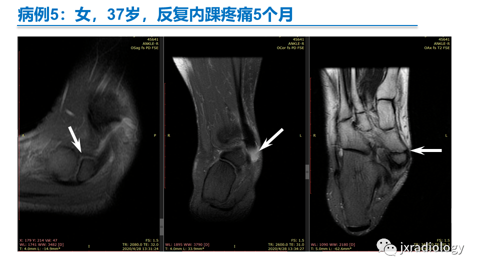 足副舟骨分型及相关病变