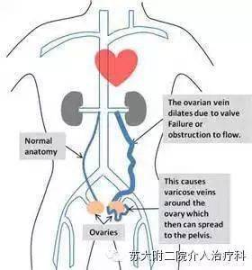 介入治疗盆腔淤血综合征有奇效_静脉