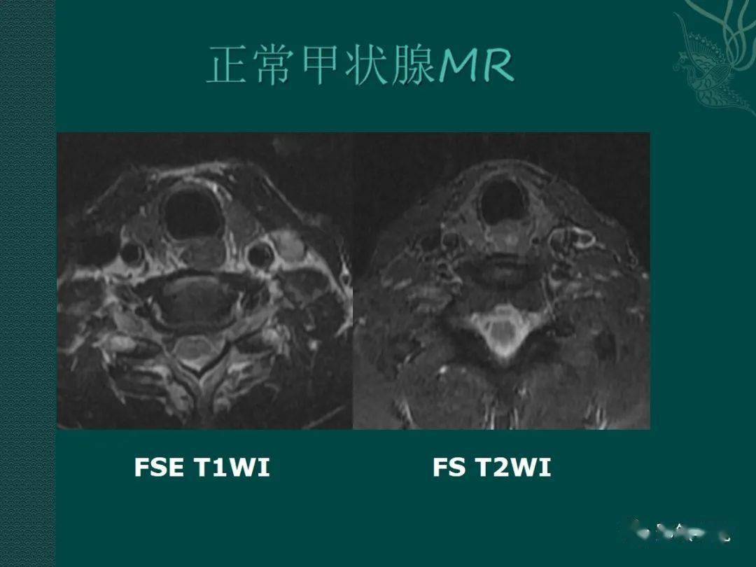 甲状腺癌的mr诊断