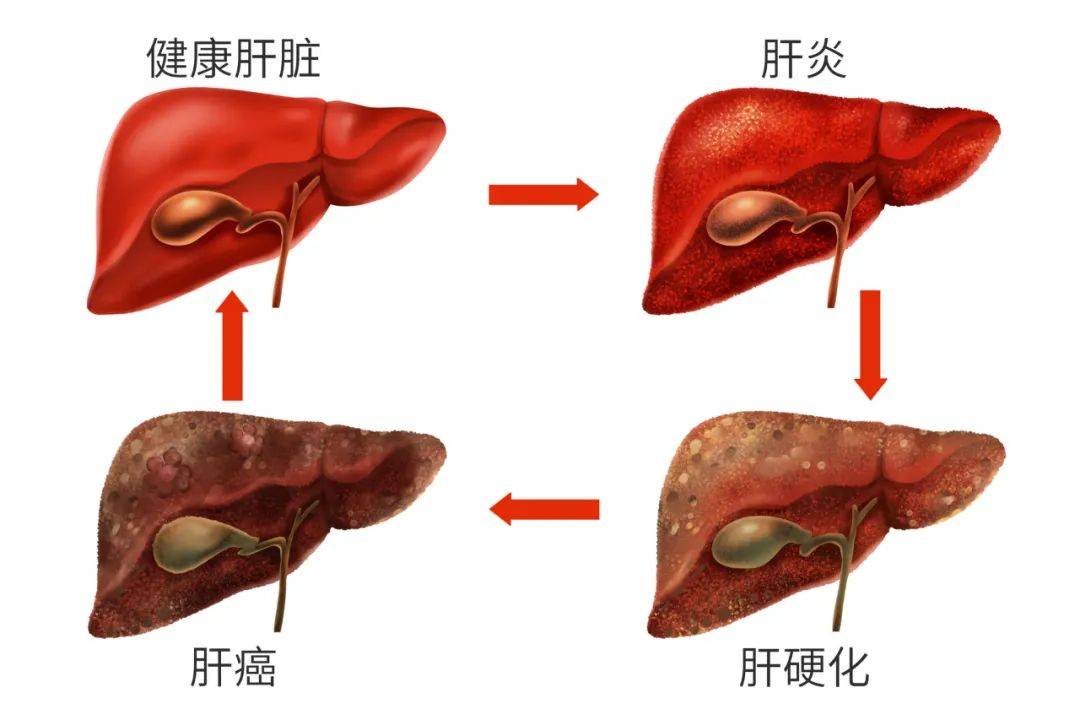 不过免疫能力正常情况下,即使感染少量病毒也能及时清除,并且肝脏的