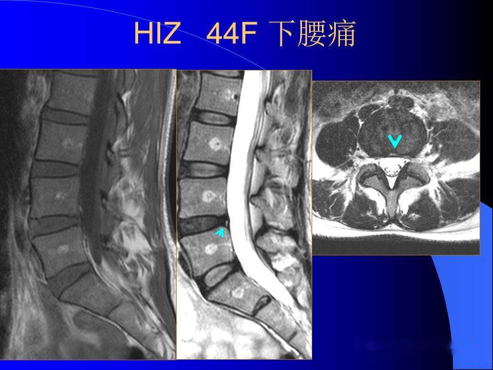 椎间盘发育退变与病变mri表现