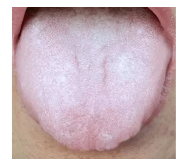 舌头中间有裂纹,或者边缘有齿痕等,是『大病征兆』?现在知道还不晚!