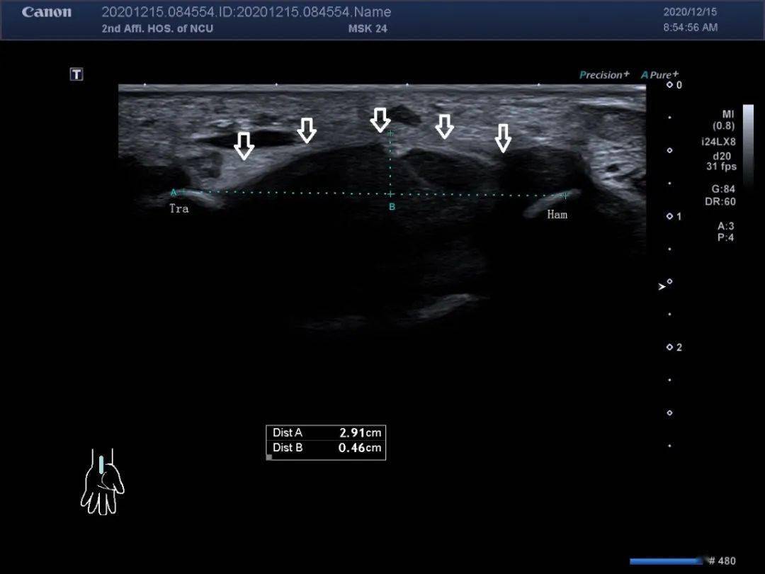 典型超声病例:腕管综合征的超声诊断思路