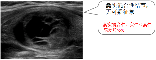甲状腺结节恶性程度如何判断超声报告单你该这样看
