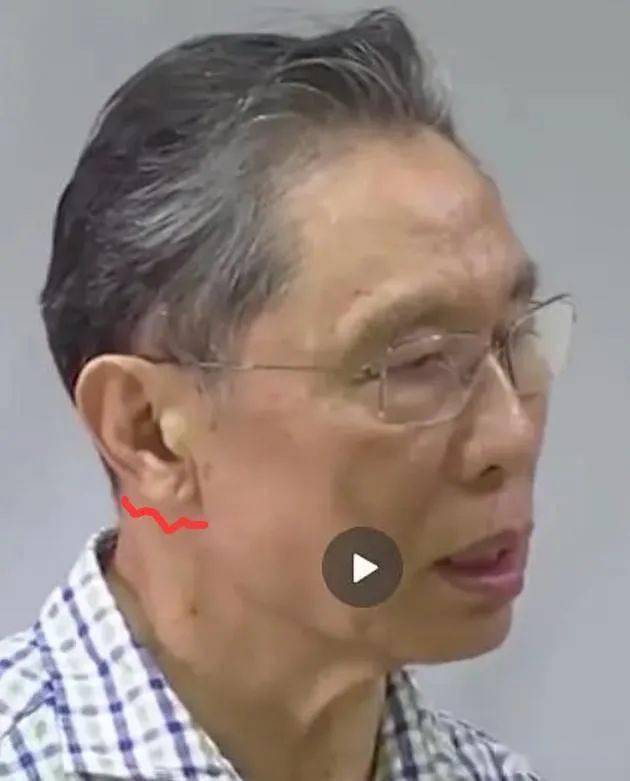 人脸竟然藏着心脏病信号