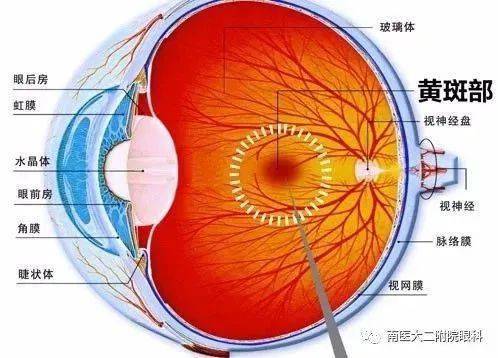 高度近视患者:剧烈运动,疲劳用眼可能导致视网膜脱离