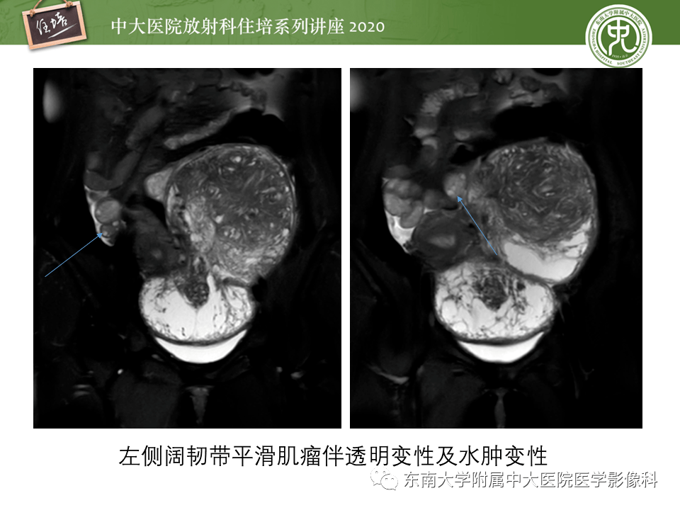 来源宫旁病变易与卵巢来源病灶混淆导致误诊,如子宫巨大浆膜下肌瘤,阔