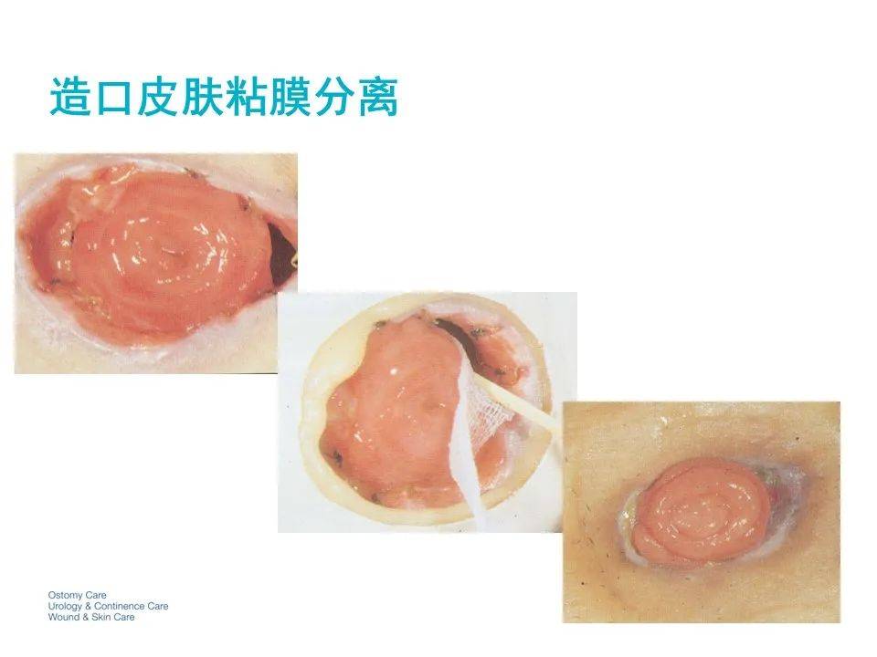 ppt造口及造口周围并发症