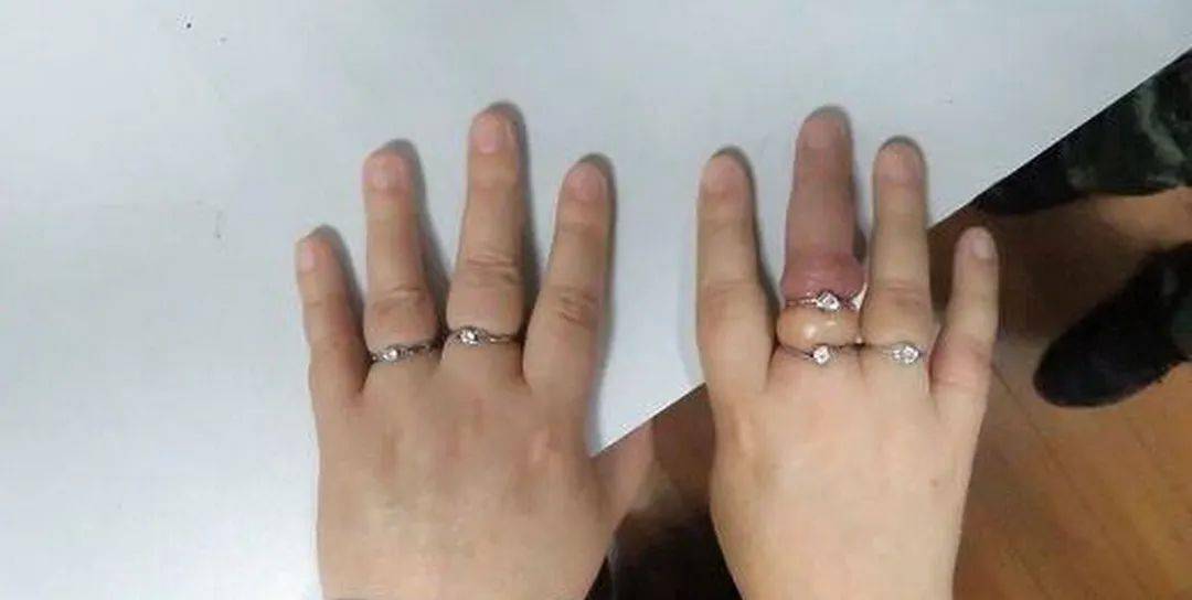 急!攀枝花一女子戒指"咬手"无法取出