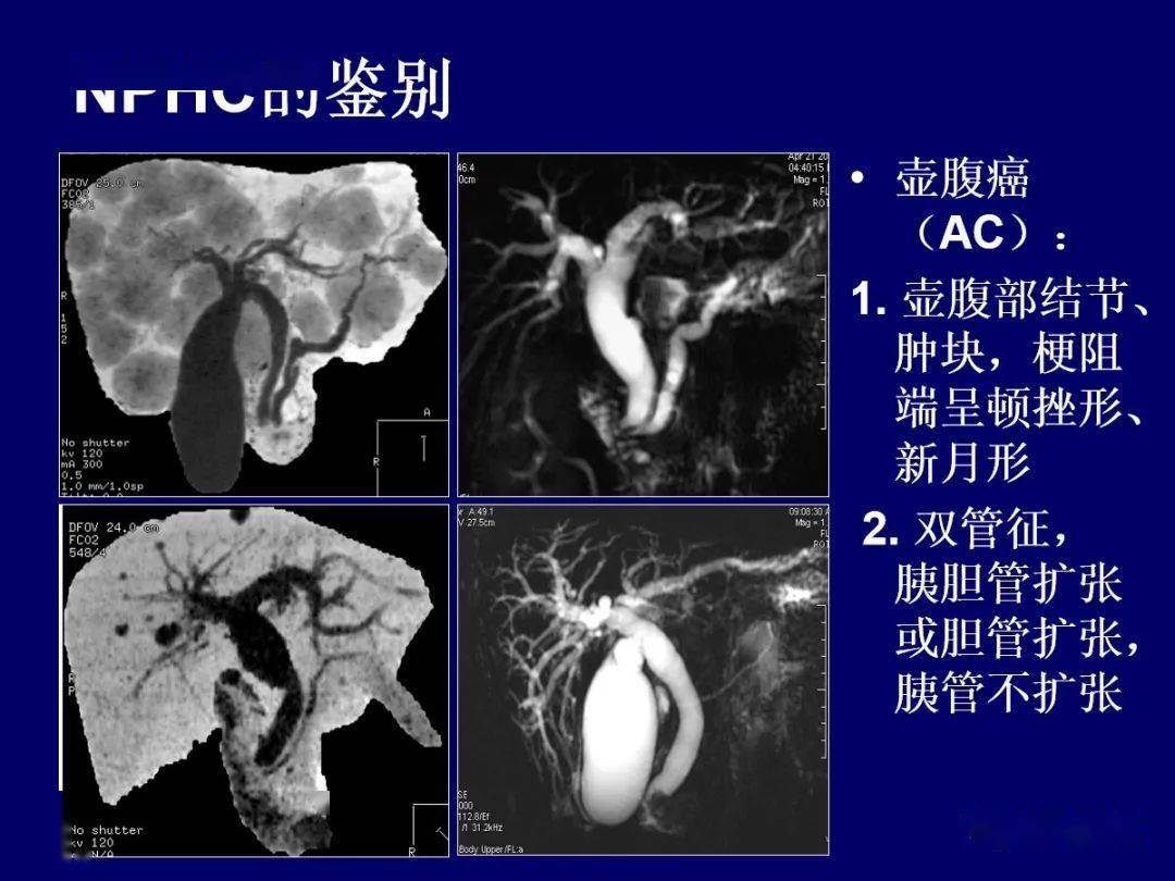 壶腹周围癌的ct,mri诊断