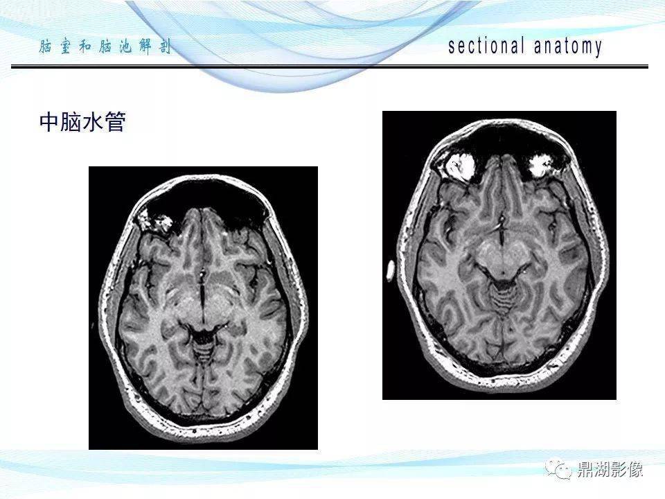 超全详解:脑池和脑室断层解剖