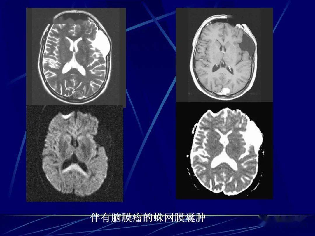 头颅mri中不同序列dwi和adc的区别