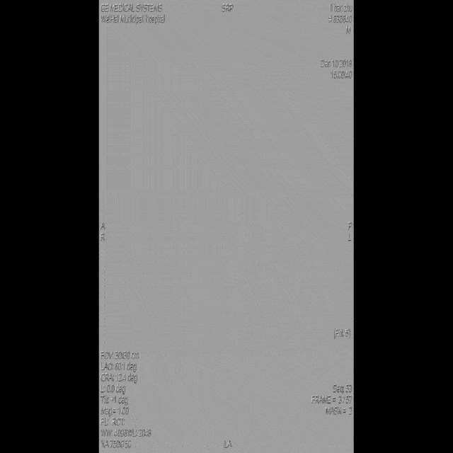 【鲁艺精粹】左侧cas术后支架内再狭窄致cca闭塞复合手术再通一例