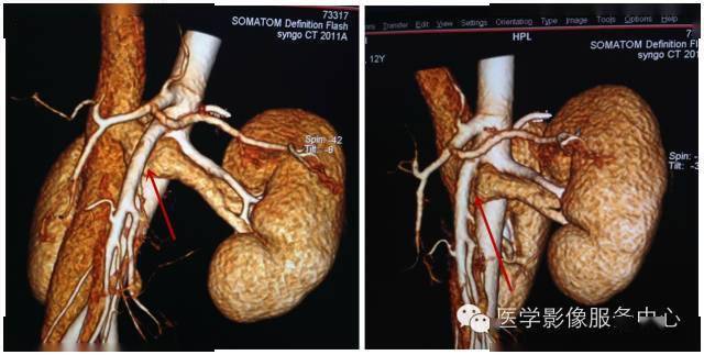 根据左肾静脉的解剖位置可将ncs分为前,后两型.