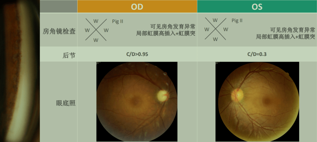 吴玲玲教授kdb内路小梁切除术初体验探访新式房角切开方式