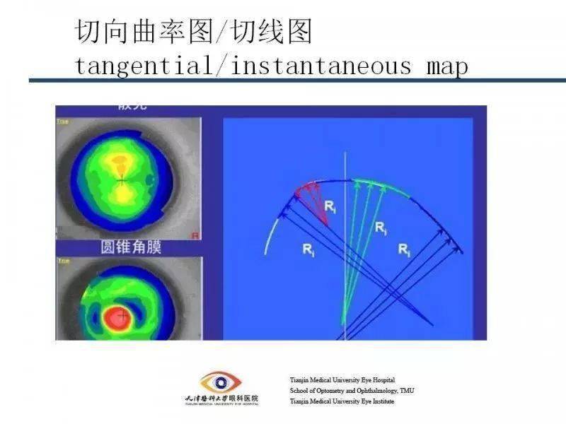 特点:轴向曲率图在中央区域精确度较高,周边部误差较大,适合正常的