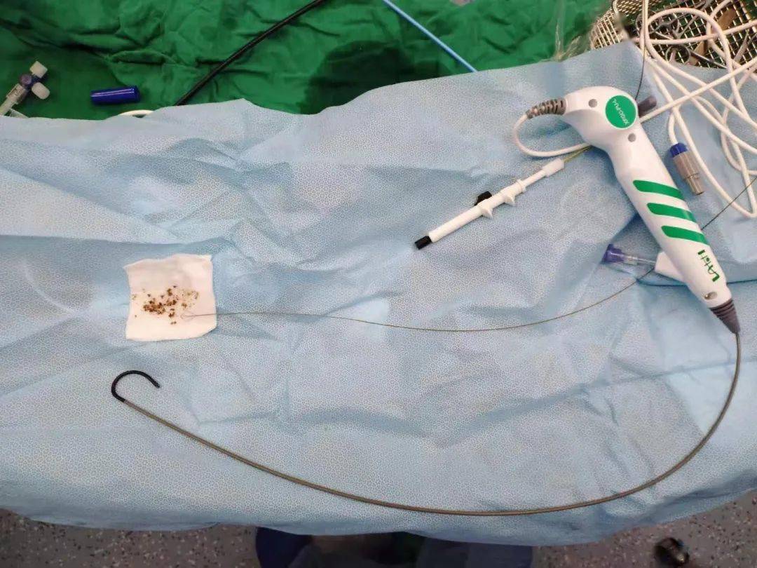 【市中医|微讯】上海市中医院泌尿外科"斑马"一次性电子输尿管软镜首