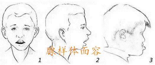 火爆抖音的腺样体肥大你恐慌了吗