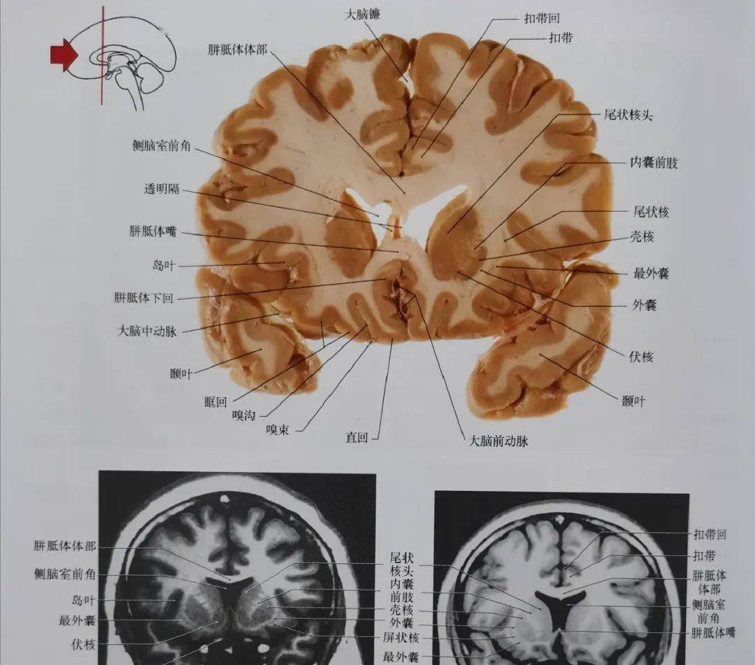 尾状核头在此冠状位平面显示非常清楚.