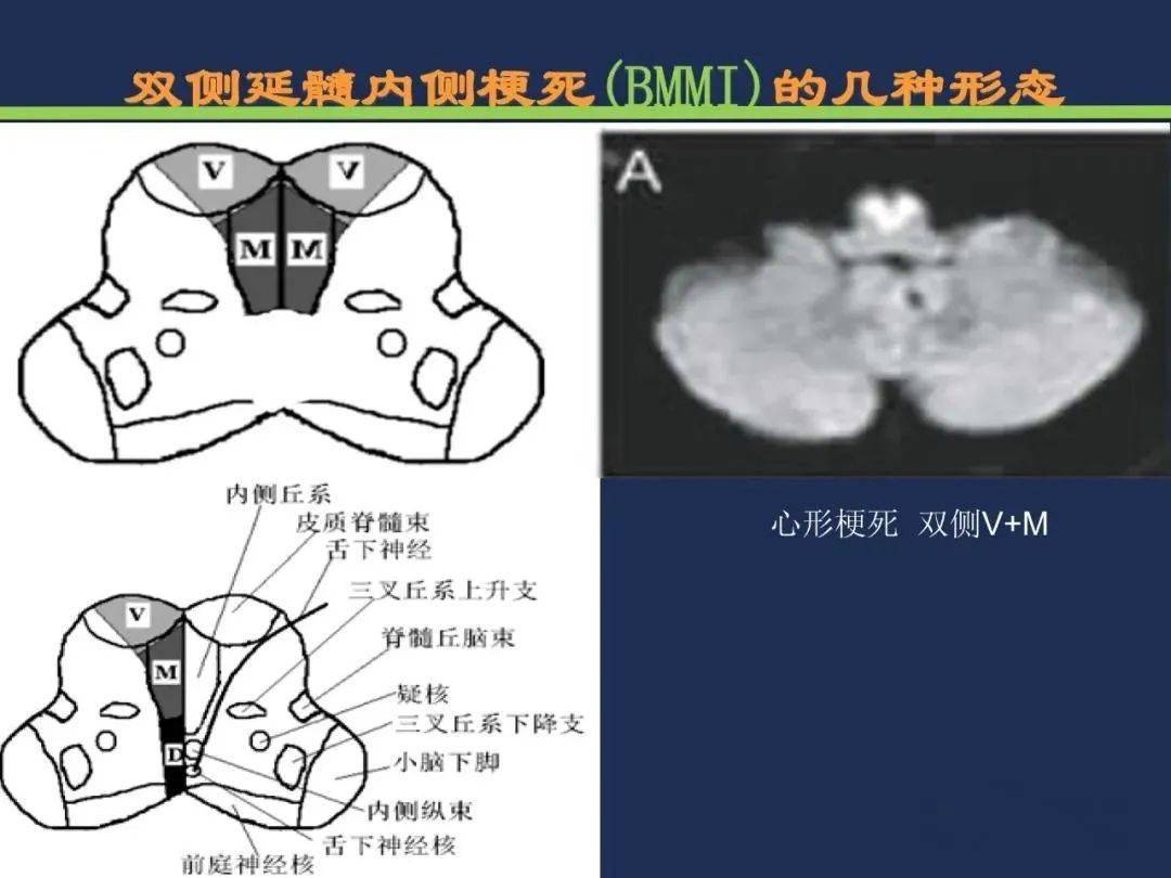 分水岭梗死皮质前型 皮质后型 后上型皮质下前型 皮质下后型 皮质下