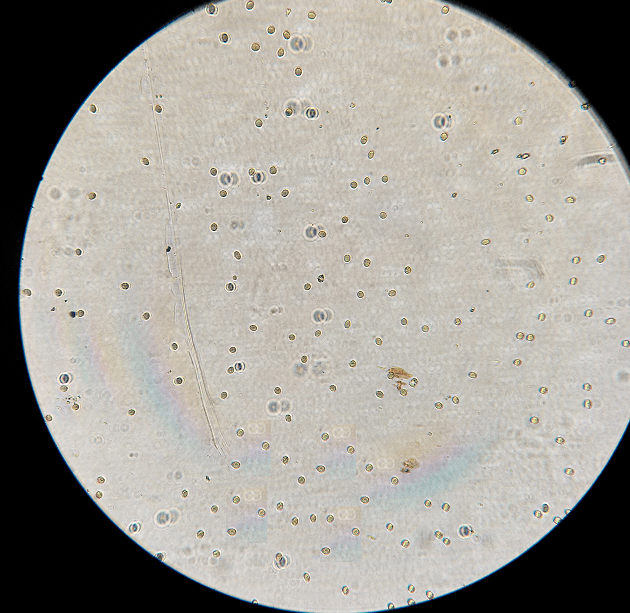 3 ),并且尿沉渣(未离心)显微镜检查结果:高倍镜下可见大量红细胞,红
