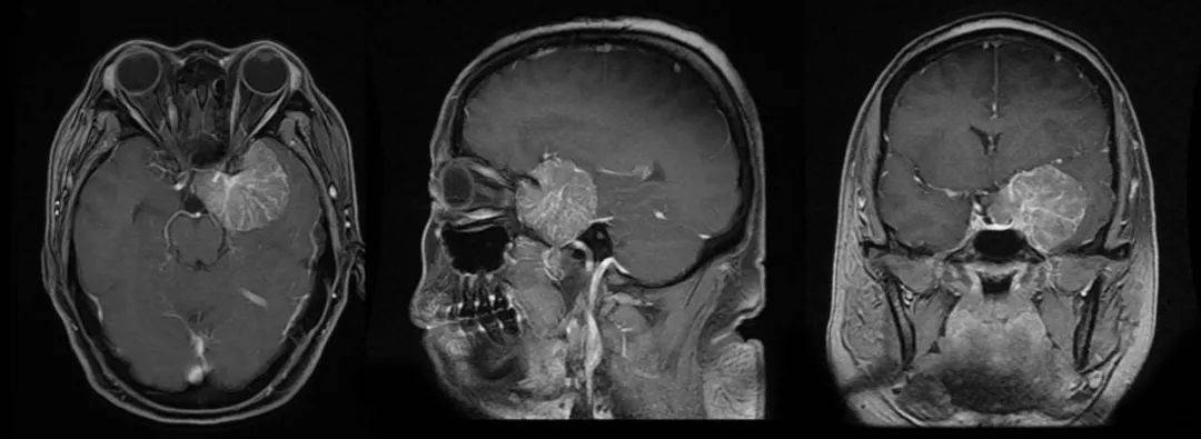 病例分享蒋磊副教授前床突脑膜瘤的手术治疗