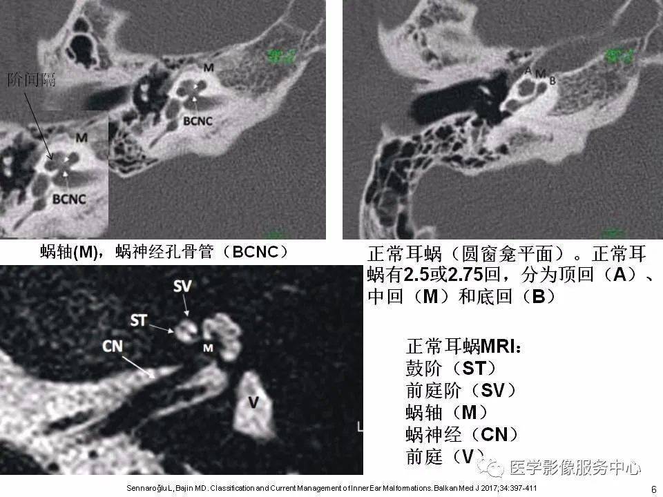 本文目录 第一部分:耳蜗解剖 第二部分:内耳畸形分类,主要基于ct 第