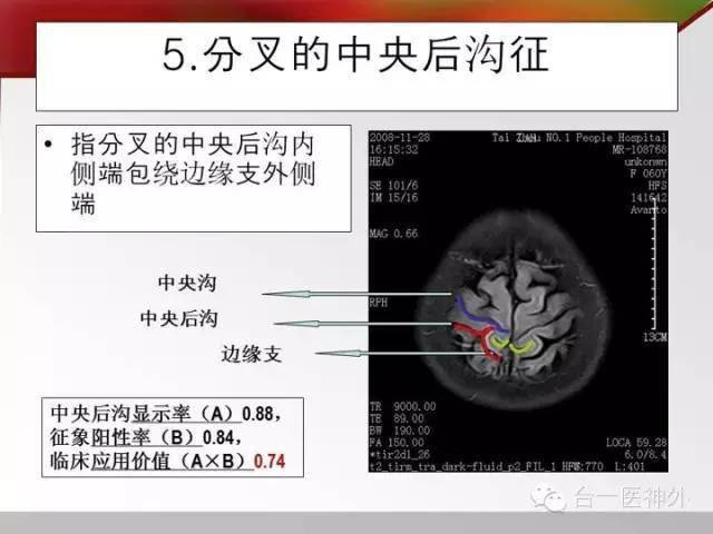 头颅mri横断面脑沟回十大征象