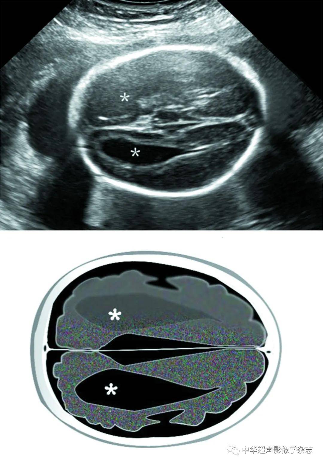 胎儿透明隔腔超声检查专家共识