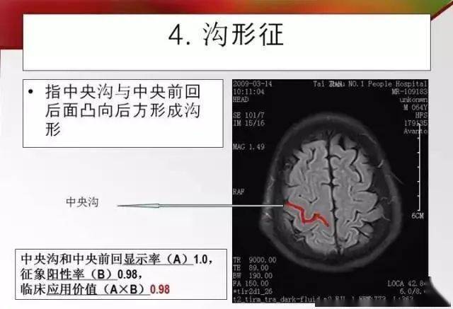 头颅mri横断面脑沟回十大征象