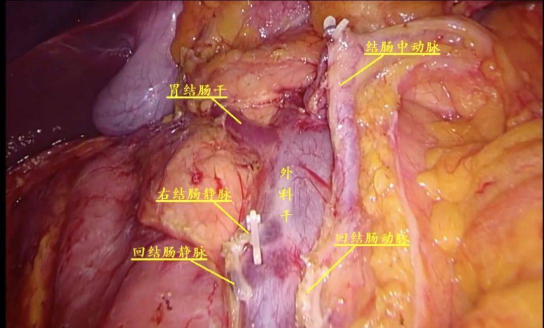 回结肠静脉 中结肠静脉 三根叉: 胃结干分支(胃网膜右静脉,右结肠静脉