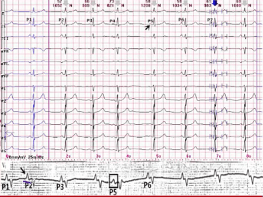 3种常见心电现象,带你看透心电图!