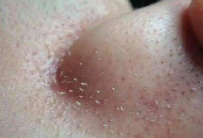 鼻子上黑头粉刺鼓鼓囊囊?3招让鼻子干净紧致!