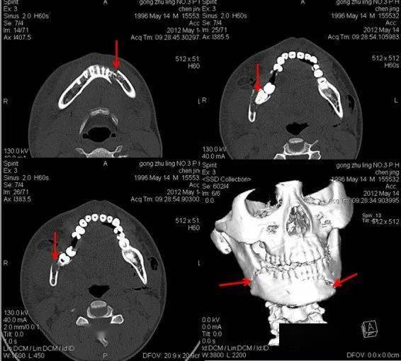 粗隆间骨折 左上:颚骨骨折 左下:上颌窦前壁骨折 右下:上颌骨额突骨折