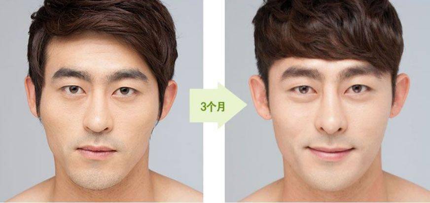 男生整容要避免女性化!
