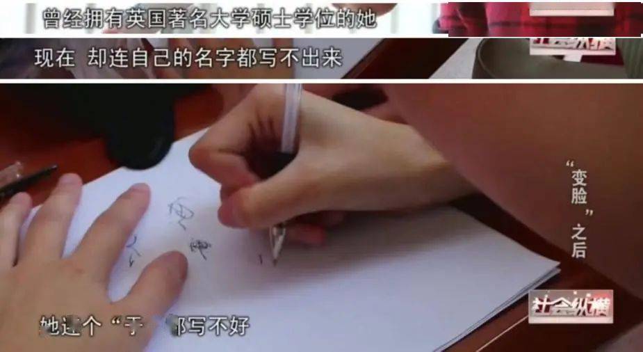 由于手术过程中大脑出血,缺氧,她患上了癫痫,永远丧失了行动能力.