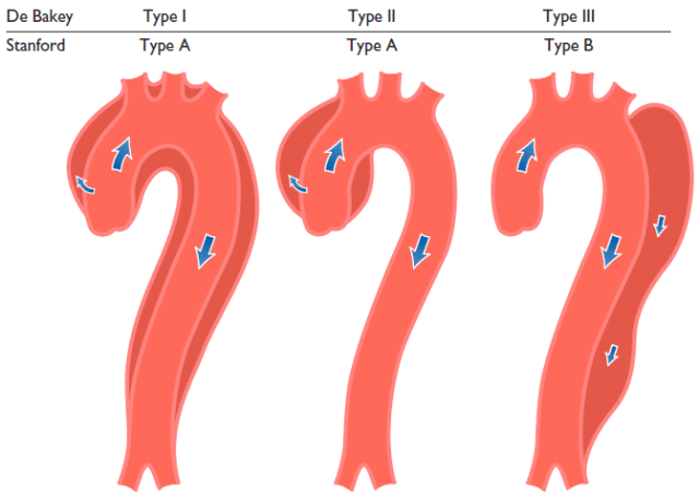 即stanford a型:累及升主动脉的夹层;stanford b型:夹层累及左锁骨下
