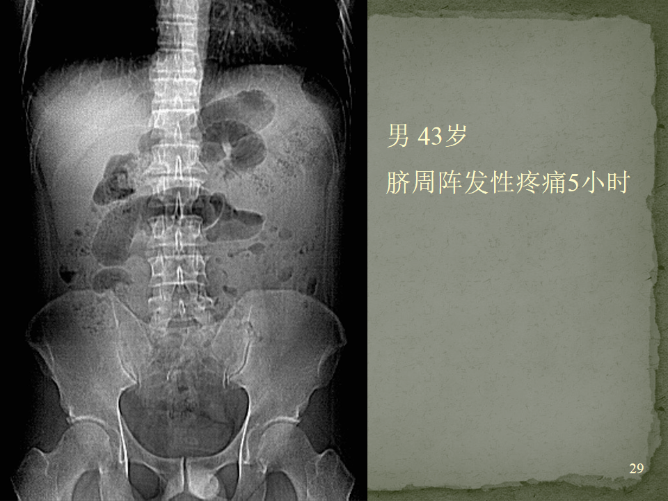 ct入门 | 肠梗阻的ct影像诊断