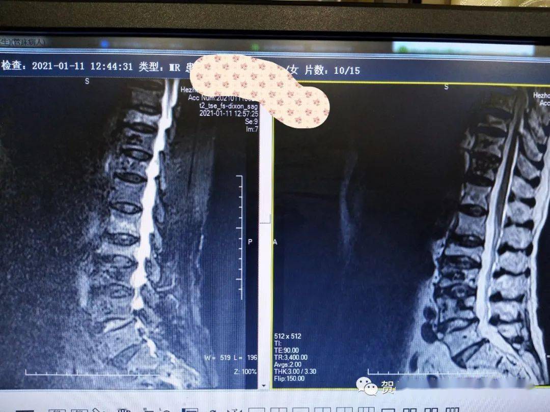 2021年1月,患者再次出现腰背痛,磁共振检查发现又有3节新鲜骨折.